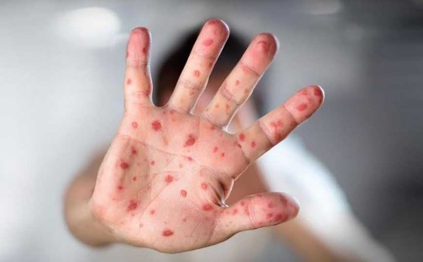 Epidemija morbila u ZDK: Na sedmičnom nivou broj zaraženih raste za oko 100 novih slučajeva